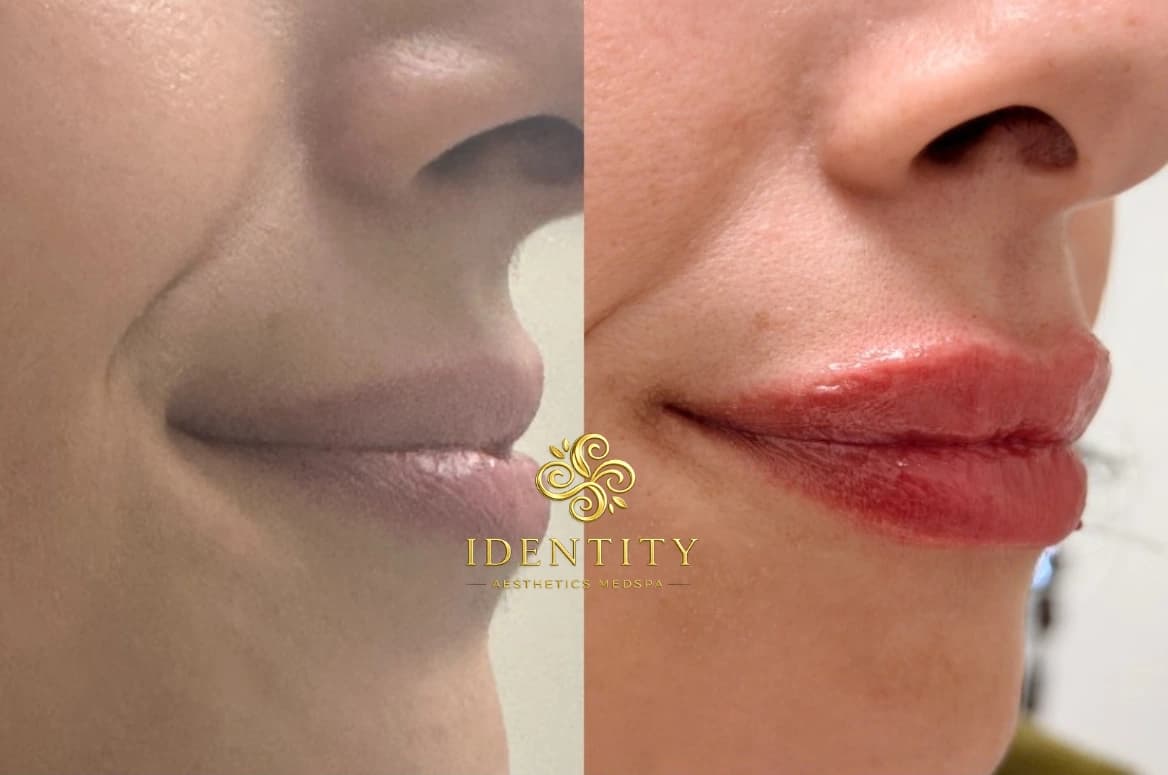 Lip enhancement case two before and after